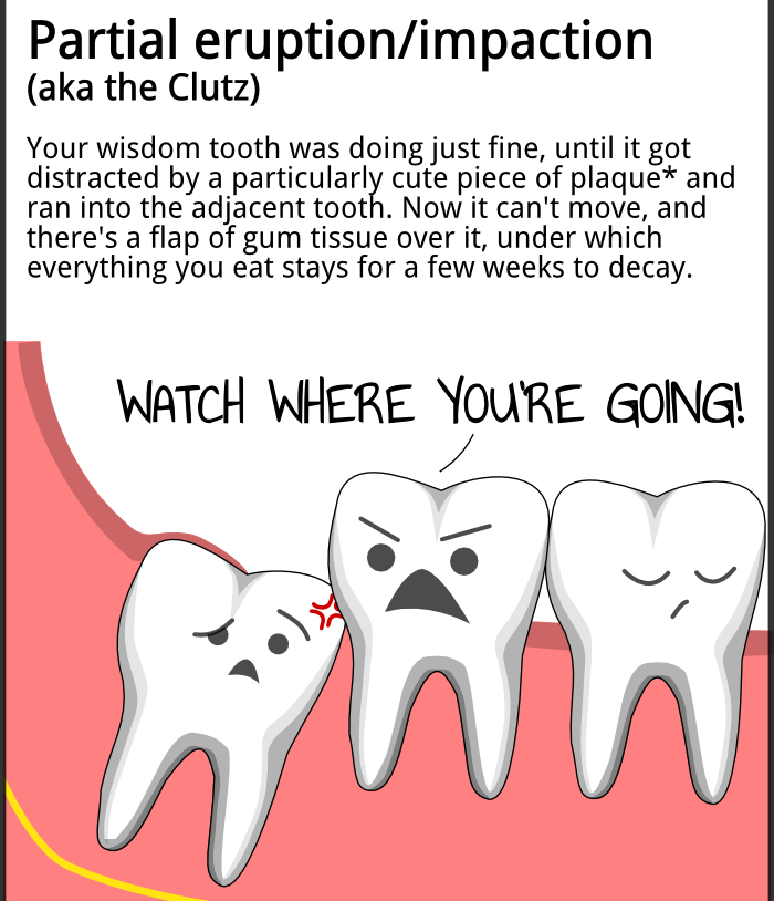 Wisdom tooth extraction Dental